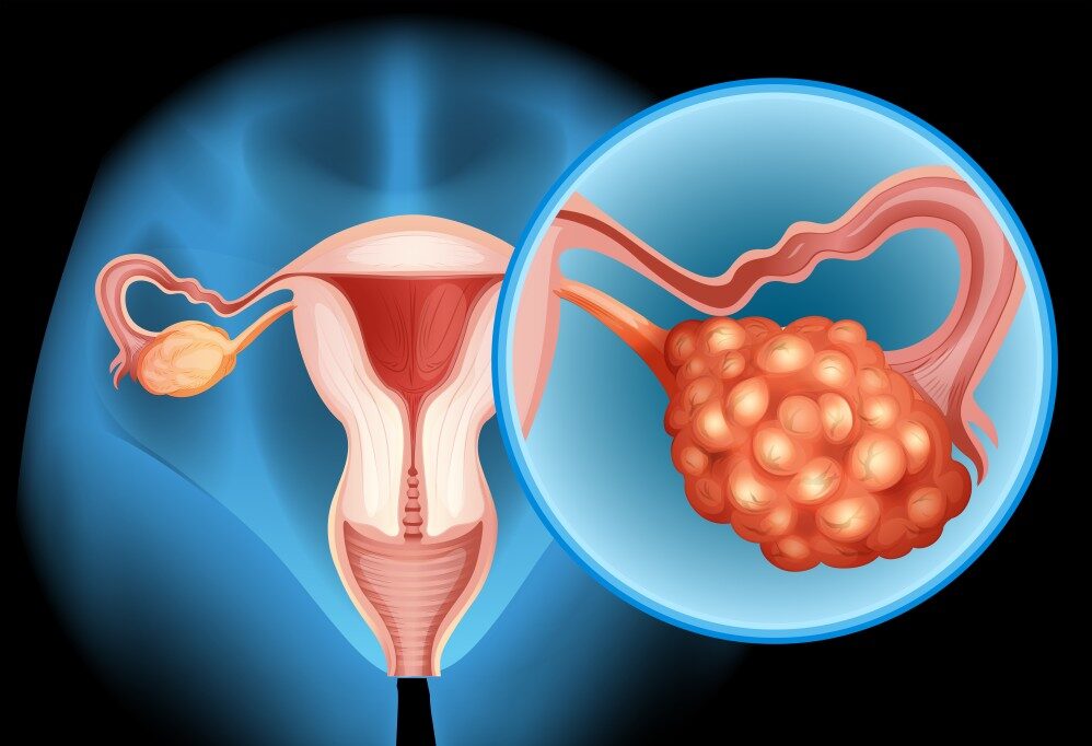 Ovarian Cyst