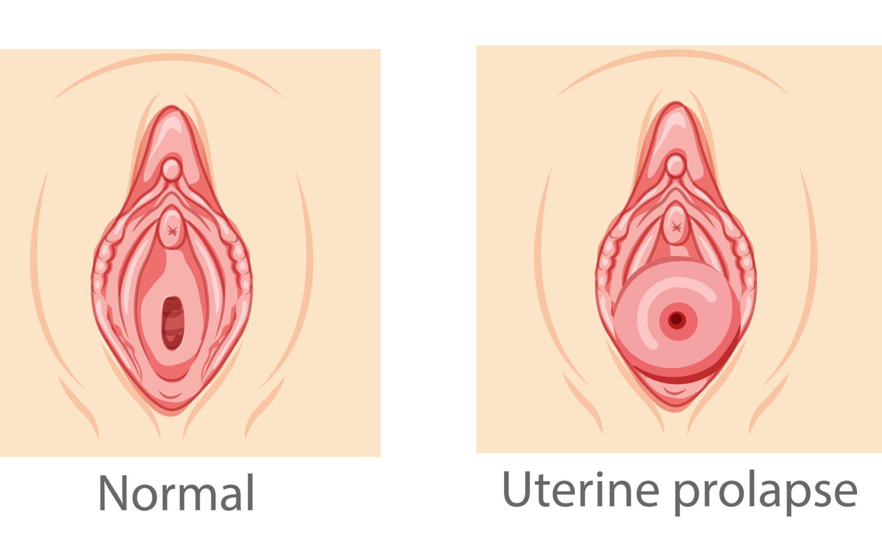 uterine-prolapse