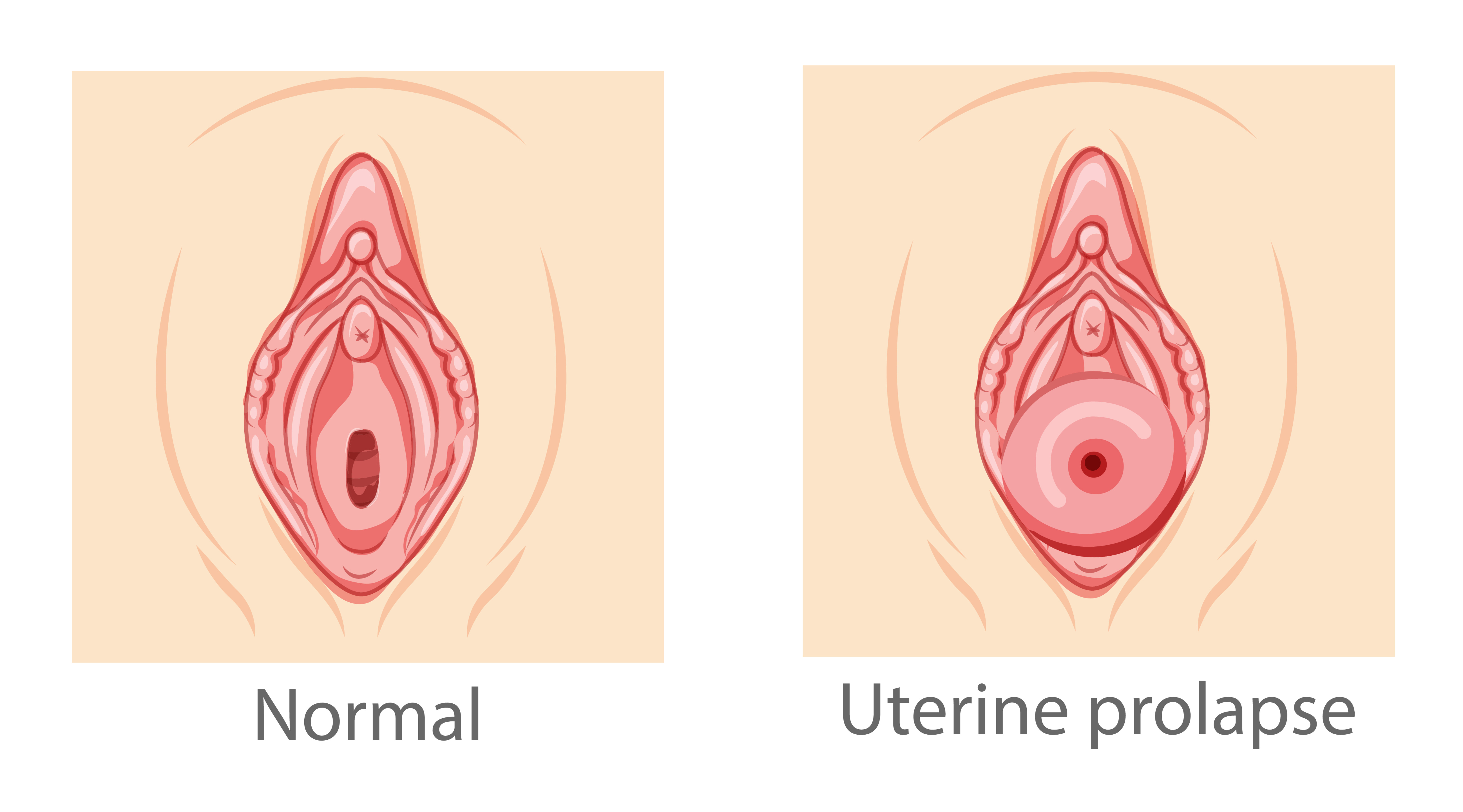 Uterine Prolapse
