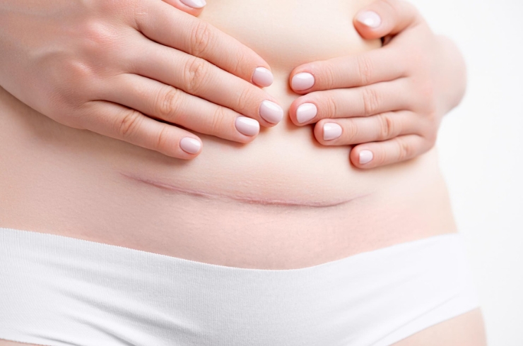 Cesarean Section