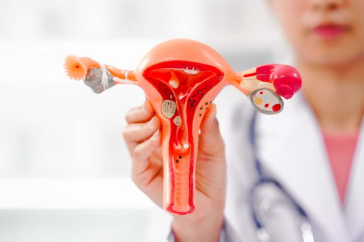 Fibroids
